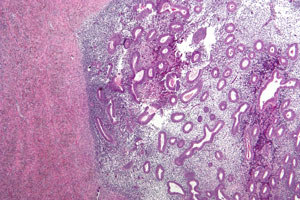An image showing endometriosis of the ovary