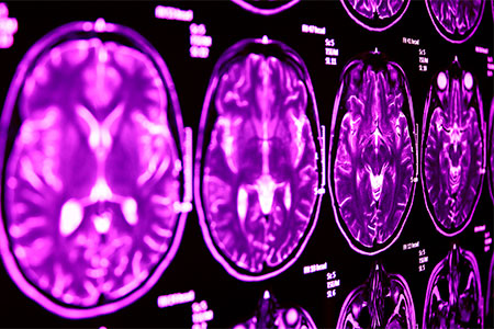 Common genetic link between autism and Tourette’s impairs brain communication