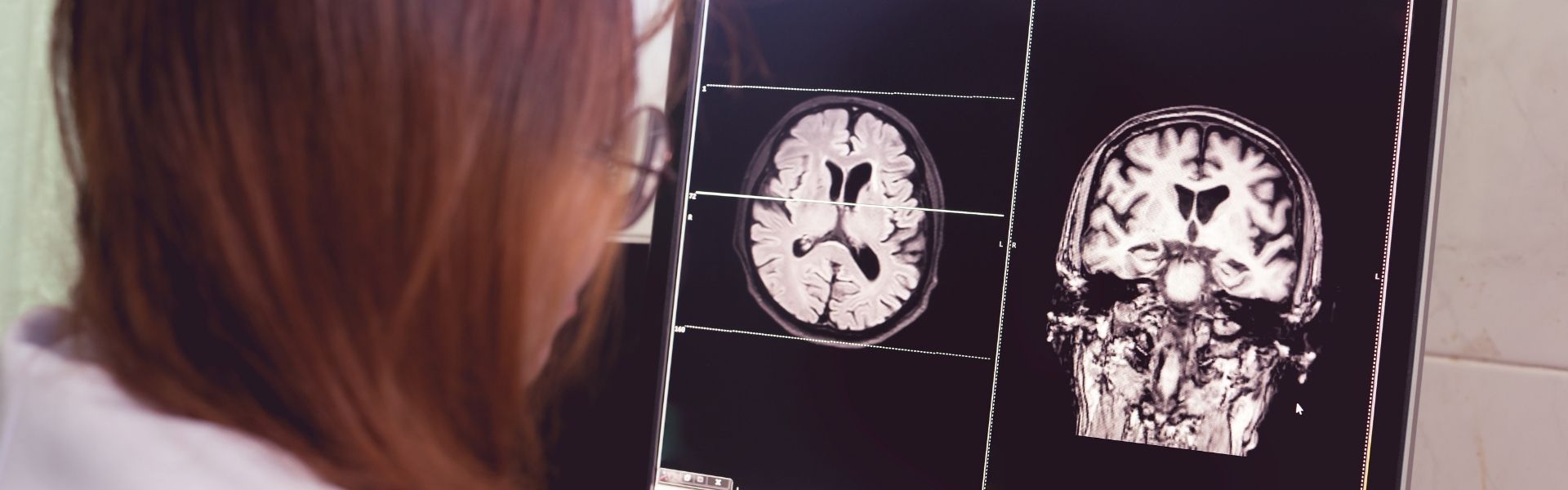 Women looking at brain scans on a computer