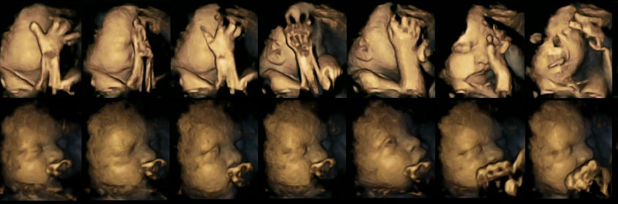 Movements in a foetus whose mother is a smoker (top) and a foetus whose mother is a non-smoker (below); credit Dr Nadja Reissland, Durham University

